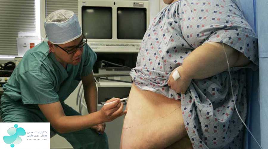 جراحی چاقی، جراحی اغری، انواع عمل های لاغری